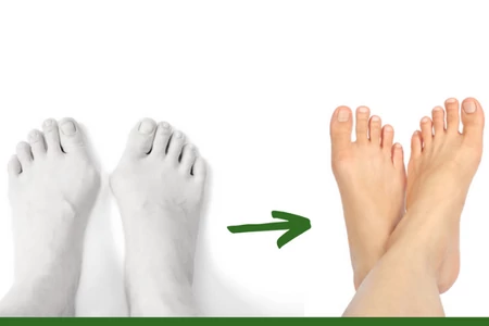 Tudta, hogy a bütykös lábujj is kezelhető?